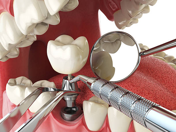 Best Lost Filling or Crown Replacement in Brown Station, MD